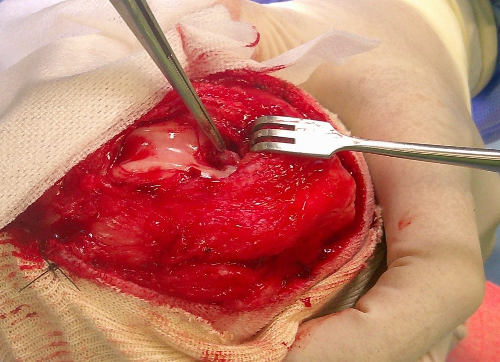 手術中の膝関節と断裂した前十字靭帯