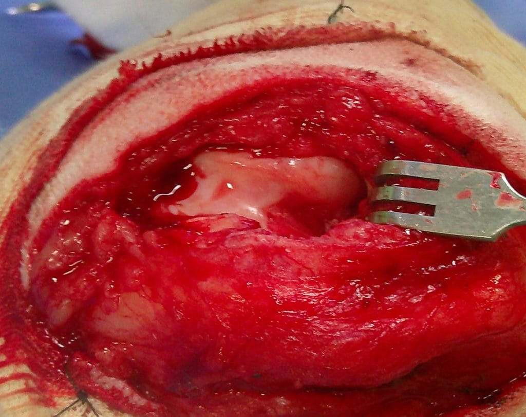 前十字靭帯を除去している手術中の様子