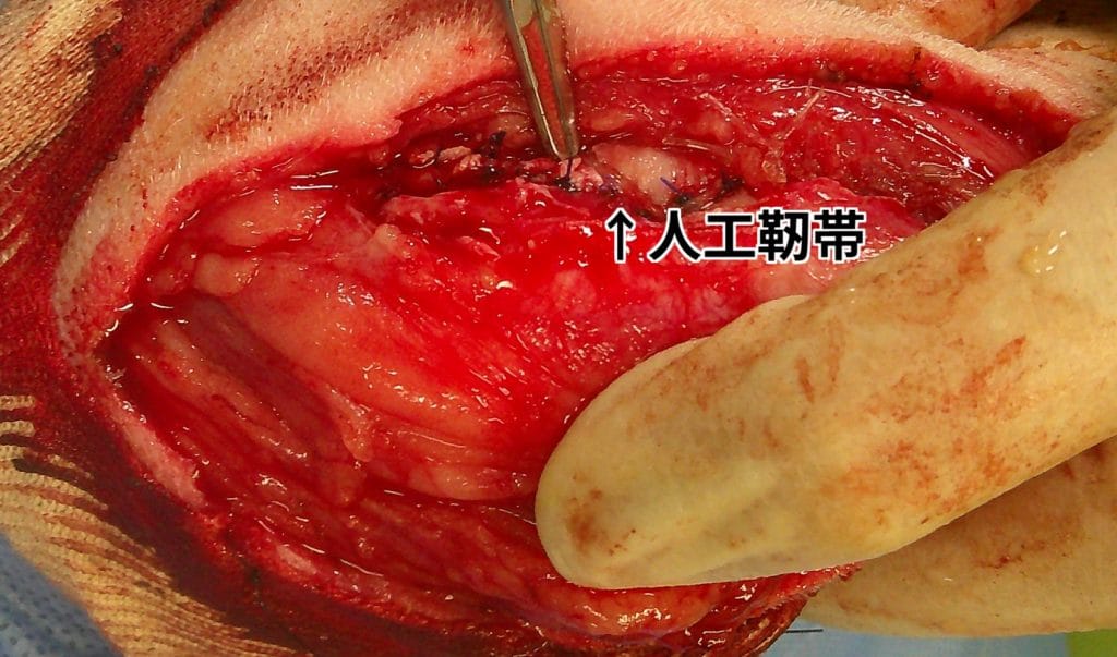 前十字靭帯断裂で人工靱帯を設置している様子