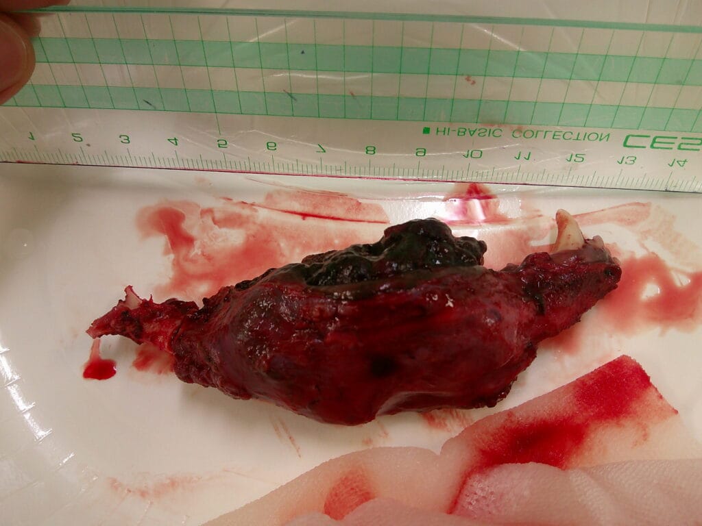 除去したメラノーマ