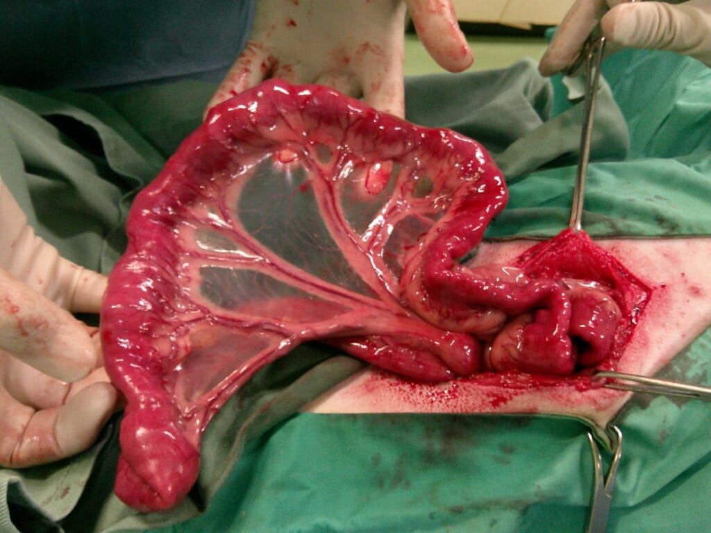 ひも状異物で腸閉塞を起こした腸の手術写真