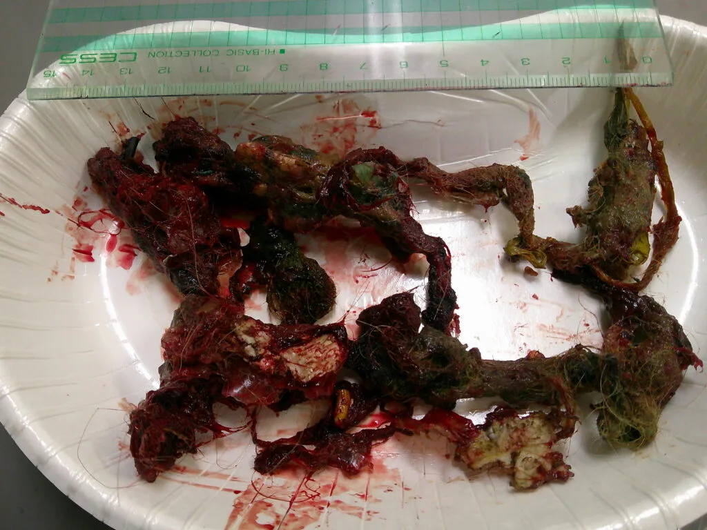 摘出したひも状異物